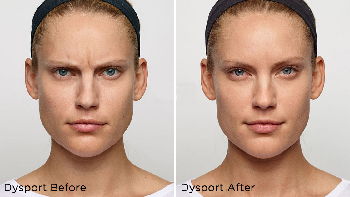 Before and after Dysport