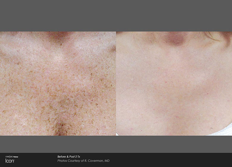 Before and after Icon treatments